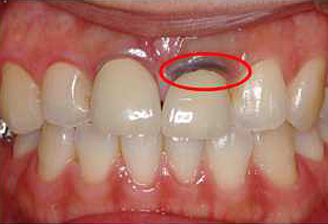 金属の土台のデメリット