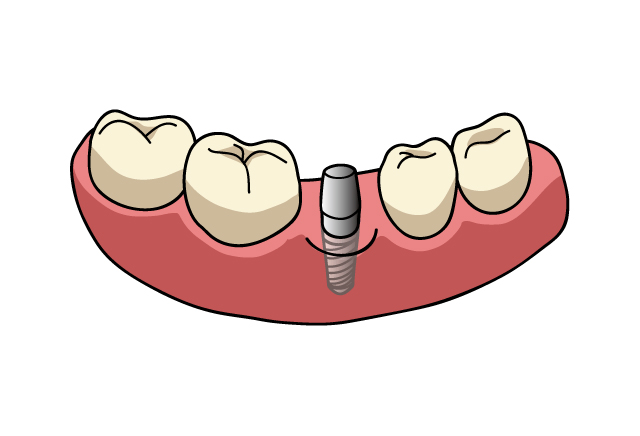 失った歯を補うインプラント