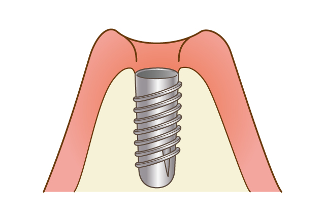 CTを使用し骨を検査