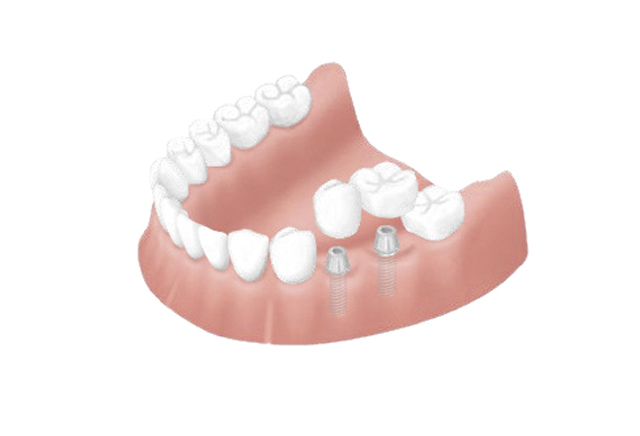 1本だけでなく上全て、下全てをインプラントで補うこともできます