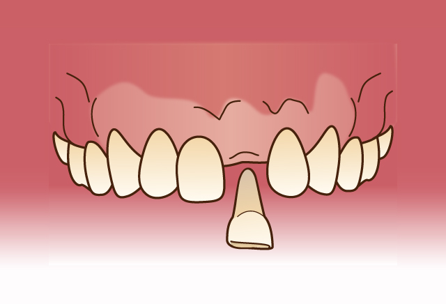 歯の移植（自家歯牙移植