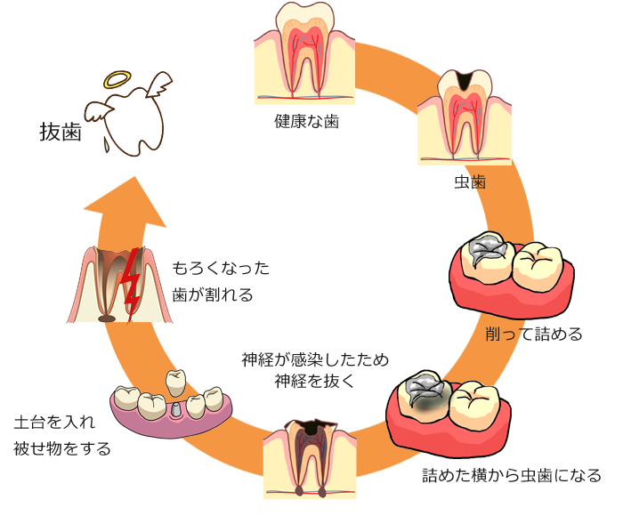虫歯治療のサイクル