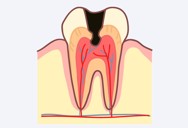 神経に虫歯が達しやすくなる