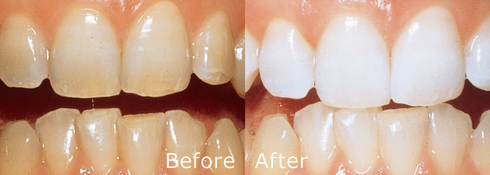 ホワイトニングの症例